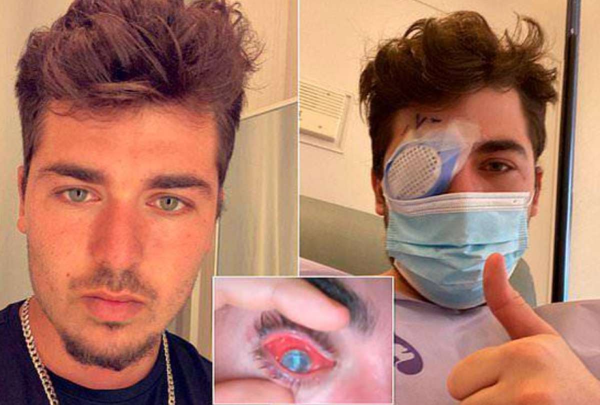 Mike Krumholz perdi&oacute; la vista, tras no quitarse los lentes de contacto.