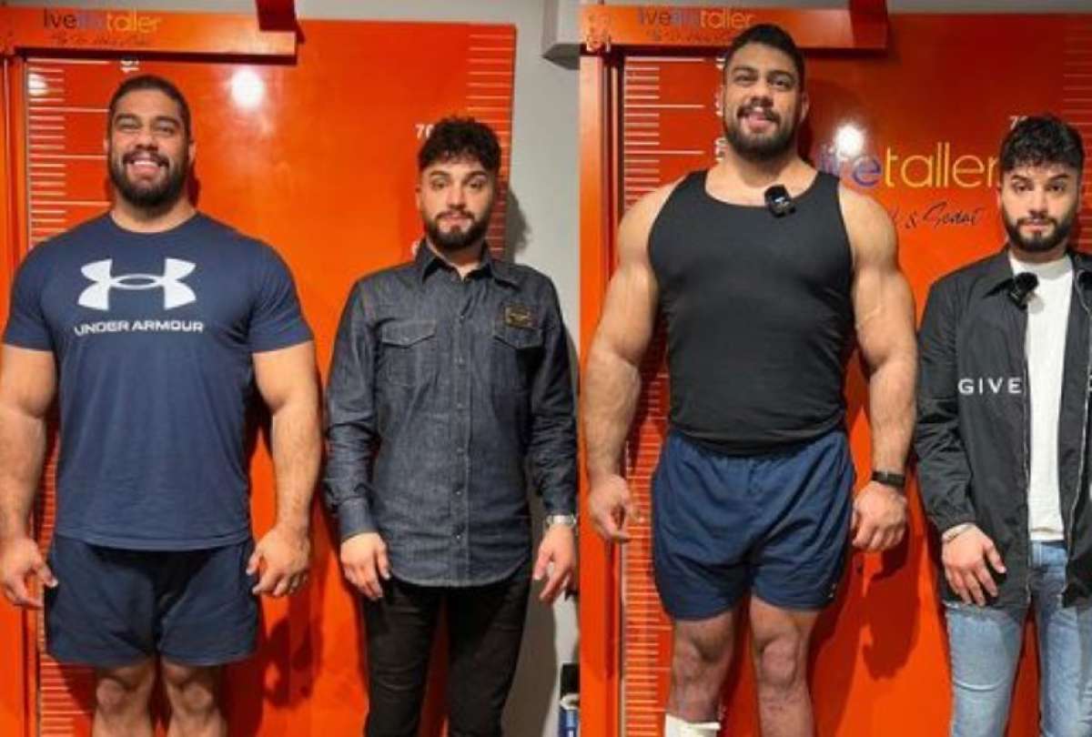 Hombre gast&oacute; casi USD 100 mil en cirug&iacute;as para aumentar de estatura