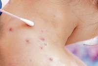 Los nuevos casos se registraron en tres provincias del país.
