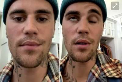 Justin Bieber sufri&oacute; par&aacute;lisis en un lado de su cara