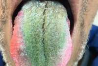 La lengua de un hombre se volvi&oacute; verde y &amp;#039;peluda&amp;#039;