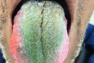 La lengua de un hombre se volvi&oacute; verde y 'peluda'