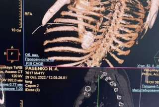 Extraen una bala alojada en el pecho de un soldado ruso