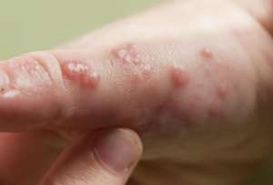 Personas con condiciones demonol&oacute;gicas son m&aacute;s vulnerables a la viruela del mono