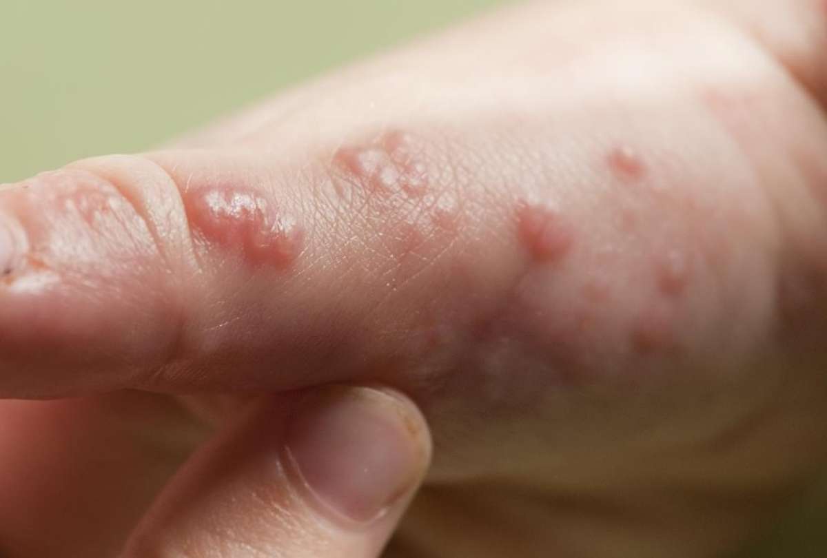 Personas con condiciones demonol&oacute;gicas son m&aacute;s vulnerables a la viruela del mono