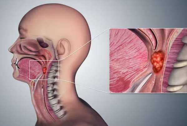 El c&aacute;ncer de garganta es cada vez m&aacute;s com&uacute;n