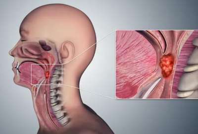 El c&aacute;ncer de garganta es cada vez m&aacute;s com&uacute;n