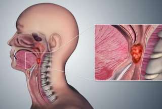 El sexo oral es un factor principal para el c&aacute;ncer de garganta