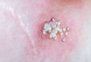 95% de los casos de viruela del mono se transmitieron v&iacute;a sexual