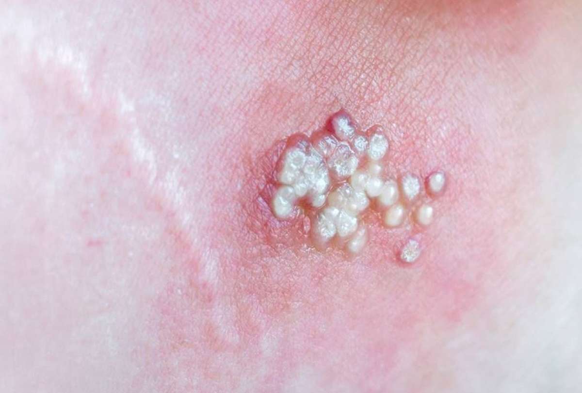 95% de los casos de viruela del mono se transmitieron v&iacute;a sexual