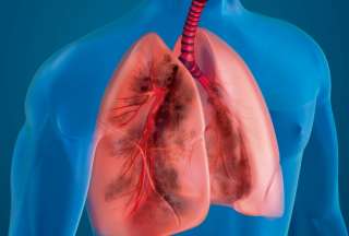 Estos son los casos de tuberculosis en el pa&iacute;s