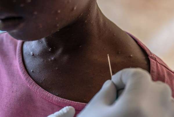 La variante clado 1B ha provocado una emergencia sanitaria en &Aacute;frica Central. 