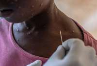 La variante clado 1B ha provocado una emergencia sanitaria en África Central.