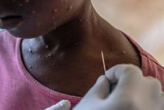 Ministerio de Salud confirm&oacute; siete casos de viruela s&iacute;mica