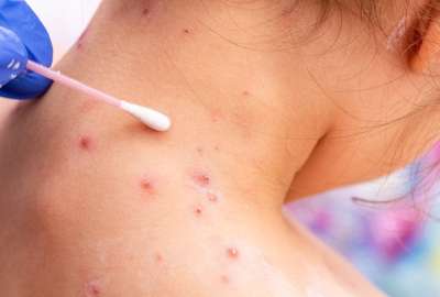 Experto asegura que la viruela del mono no se convertir&aacute; en una pandemia