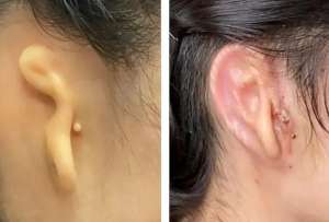Cient&iacute;ficos reconstruyen una oreja gracias a tejido de c&eacute;lulas humanas impreso en 3D