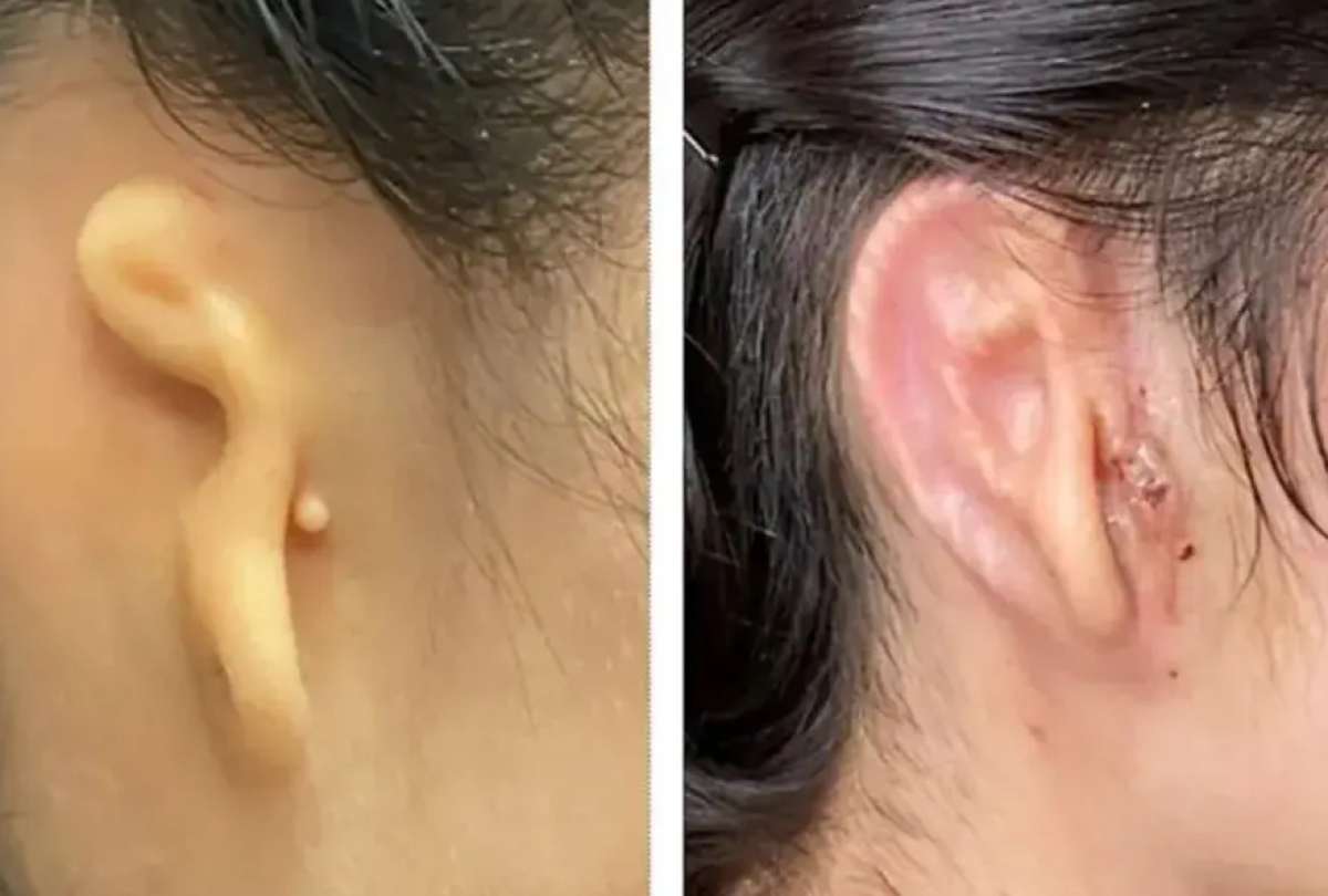 Cient&iacute;ficos reconstruyen una oreja gracias a tejido de c&eacute;lulas humanas impreso en 3D