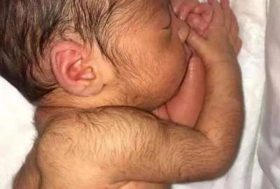 Una investigaci&oacute;n en Espa&ntilde;a revel&oacute; por qu&eacute; los beb&eacute;s nacen con este s&iacute;ndrome. 