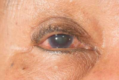 &iquest;Qui&eacute;nes tienen mayor riesgo de desarrollar el glaucoma?