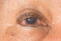 &iquest;Qui&eacute;nes tienen mayor riesgo de desarrollar el glaucoma?