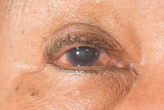 &iquest;Qui&eacute;nes tienen mayor riesgo de desarrollar el glaucoma?