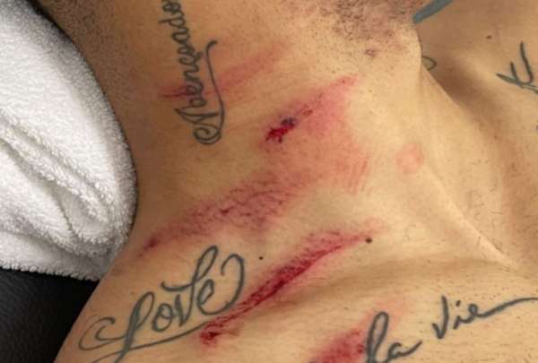 Matheus Cunha mand&oacute; un mensaje luego de las huellas que le dej&oacute; Dom&iacute;nguez en su cuello