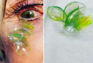 Una oftalm&oacute;loga retir&oacute; 23 lentes de contacto del ojo de su paciente