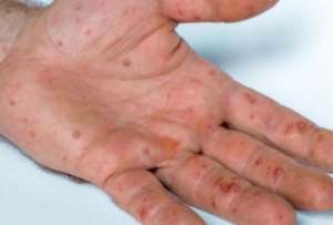 Ecuador registra 142 casos de viruela del mono