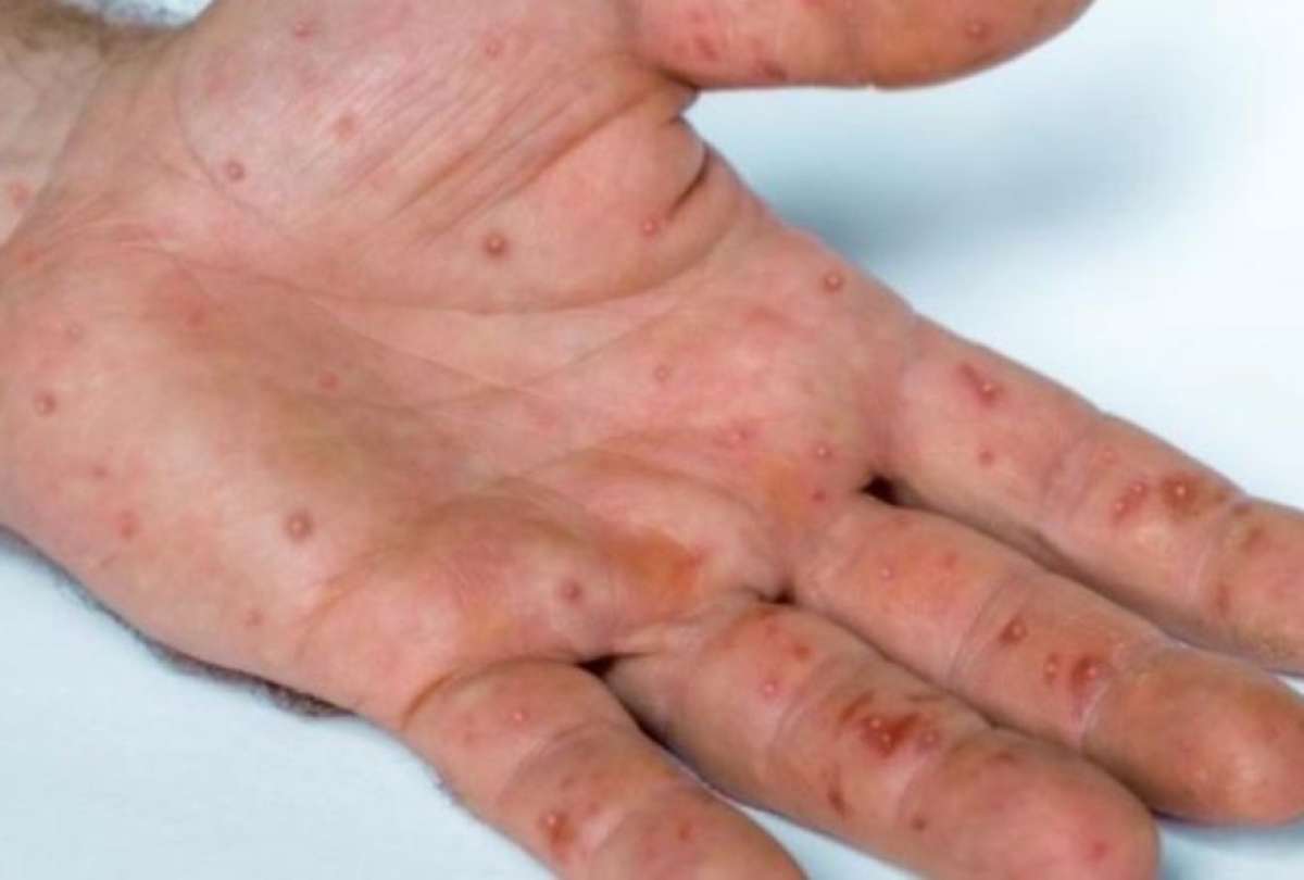 Ecuador registra 142 casos de viruela del mono