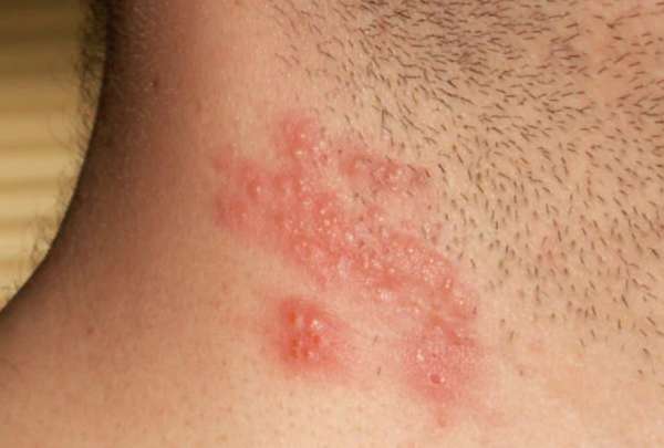 El herpes z&oacute;ster es causado por el virus de la varicela; presenta quemaz&oacute;n y dolor en la piel