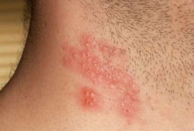 El herpes z&oacute;ster es causado por el virus de la varicela; presenta quemaz&oacute;n y dolor en la piel
