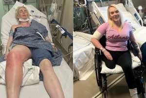 Modelo estadounidense padeci&oacute; una fuerte infecci&oacute;n por una bacteria carn&iacute;vora 