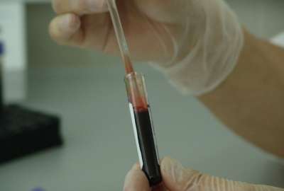 Cient&iacute;ficos identifican una nueva mutaci&oacute;n de VIH