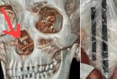 Extraen dos palillos de la nariz de un hombre en Vietnam