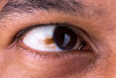 &iquest;C&oacute;mo prevenir el c&aacute;ncer de ojo?