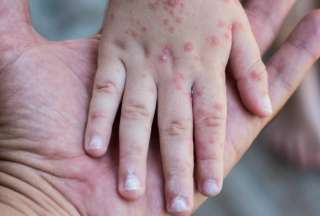 Estos son los s&iacute;ntomas de la polio, rubeola y sarampi&oacute;n