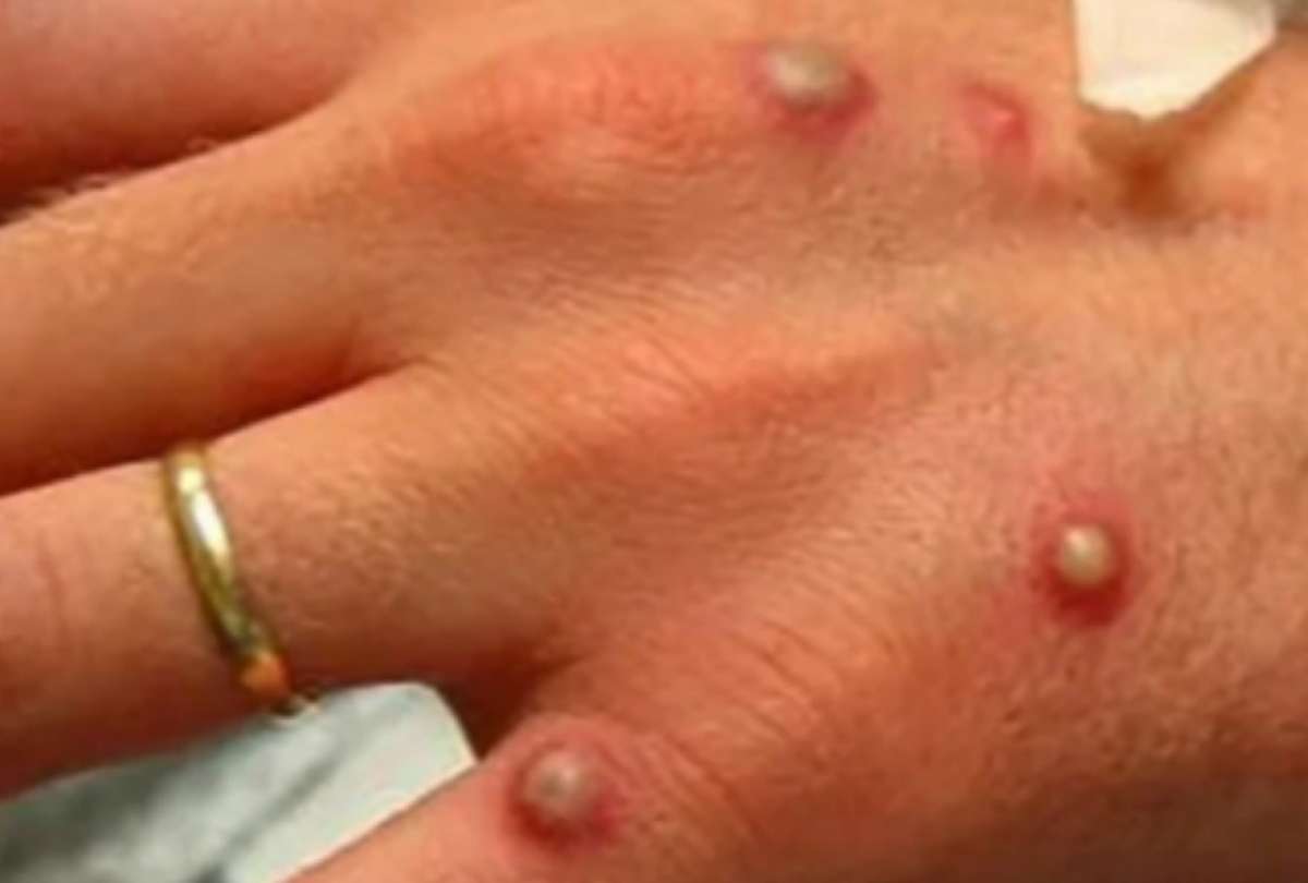 Pichincha encabeza la lista de provincias con m&aacute;s casos de viruela del mono: 161 de 421 confirmados. 