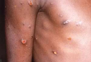 Estudio descubre nuevos s&iacute;ntomas cl&iacute;nicos de la viruela del mono