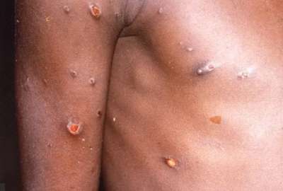 Estudio descubre nuevos s&iacute;ntomas cl&iacute;nicos de la viruela del mono