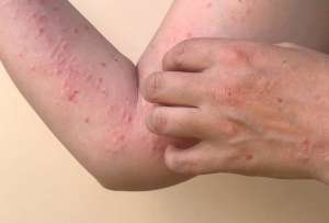 Ecuador registr&oacute; un incremento de 14 casos de MPOX. 