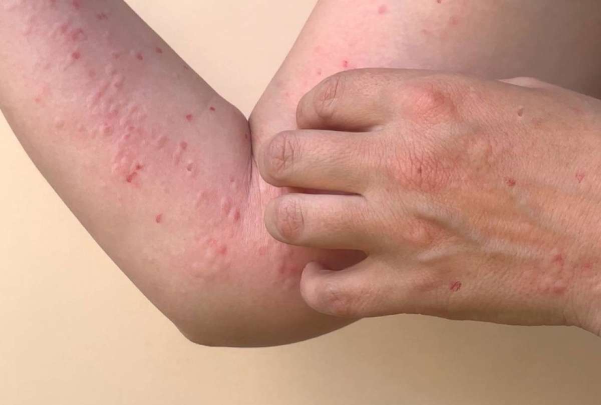 Ecuador registr&oacute; un incremento de 14 casos de MPOX. 