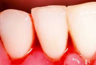 El sangrado de las enc&iacute;as podr&iacute;a ser una se&ntilde;al de la enfermedad periodontal