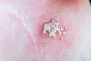 Reportan cu&aacute;l es el s&iacute;ntoma m&aacute;s com&uacute;n de la viruela del mono