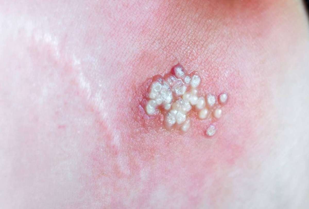 Reportan cu&aacute;l es el s&iacute;ntoma m&aacute;s com&uacute;n de la viruela del mono