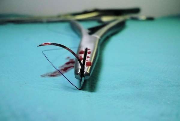Primera operaci&oacute;n de rodilla realizada por un robot en China