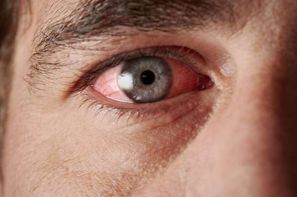 Causas y tratamientos del ojo rojo en las festividades de A&ntilde;o Nuevo