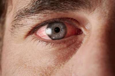 Causas y tratamientos del ojo rojo en las festividades de A&ntilde;o Nuevo