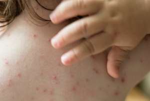 Casos de viruela del mono tambi&eacute;n est&aacute;n a la baja en Ecuador