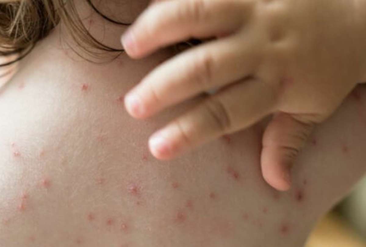 Casos de viruela del mono tambi&eacute;n est&aacute;n a la baja en Ecuador