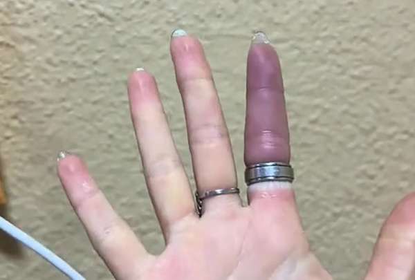 Los bomberos utilizaron herramientas de precisi&oacute;n para cortar el anillo y liberar el dedo de la joven.